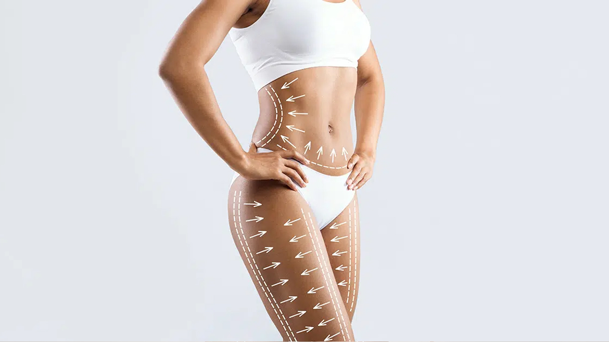 360 Liposuction için temsili kapak görseli