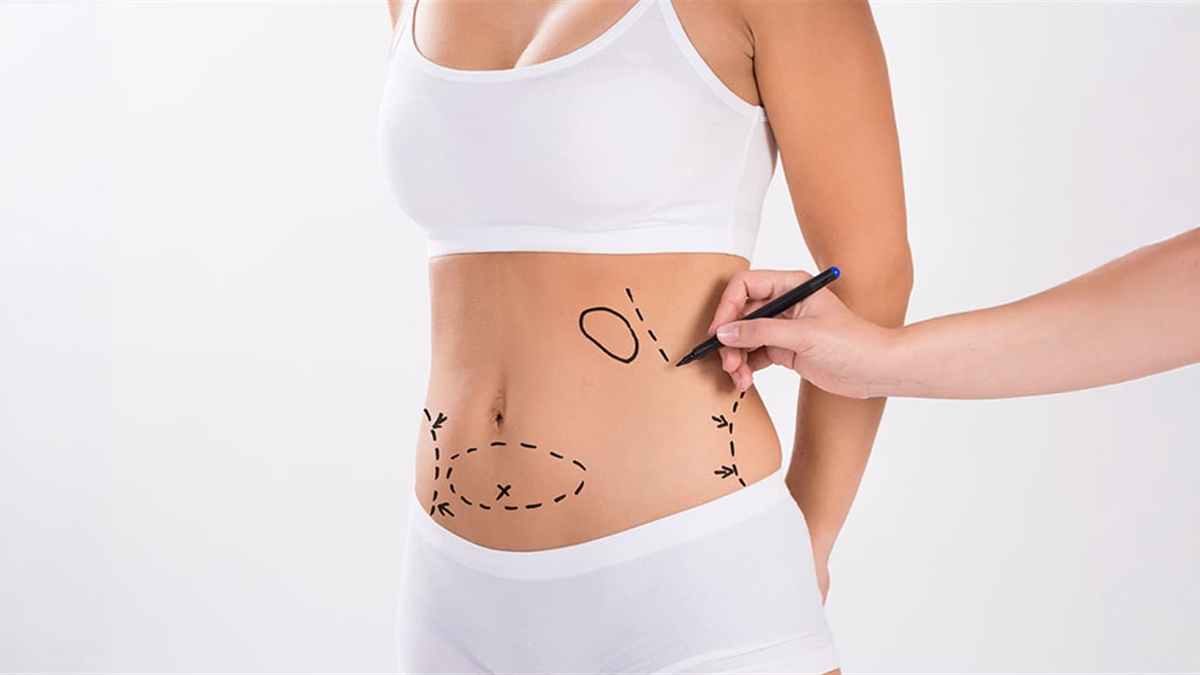 Liposuction için temsili görsel